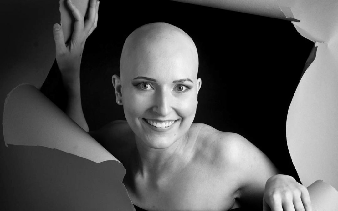 Alopecia areata – Hannah