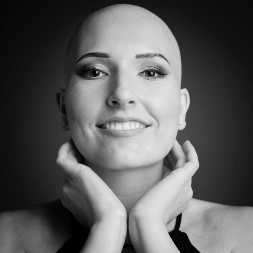 Alopecia areata, Portrait, Düsseldorf